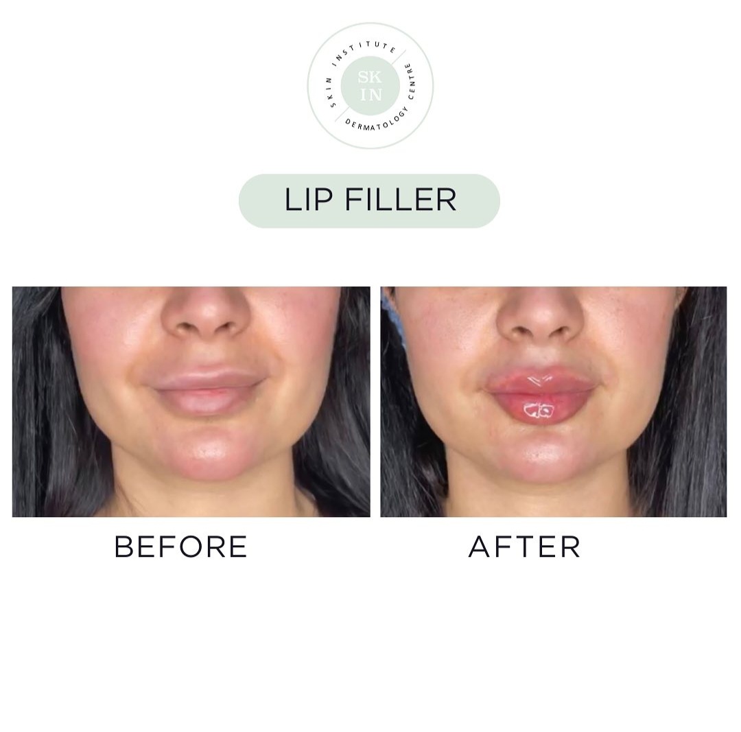 Top Rated Lip Filler Treatments Available In Abu Dhabi