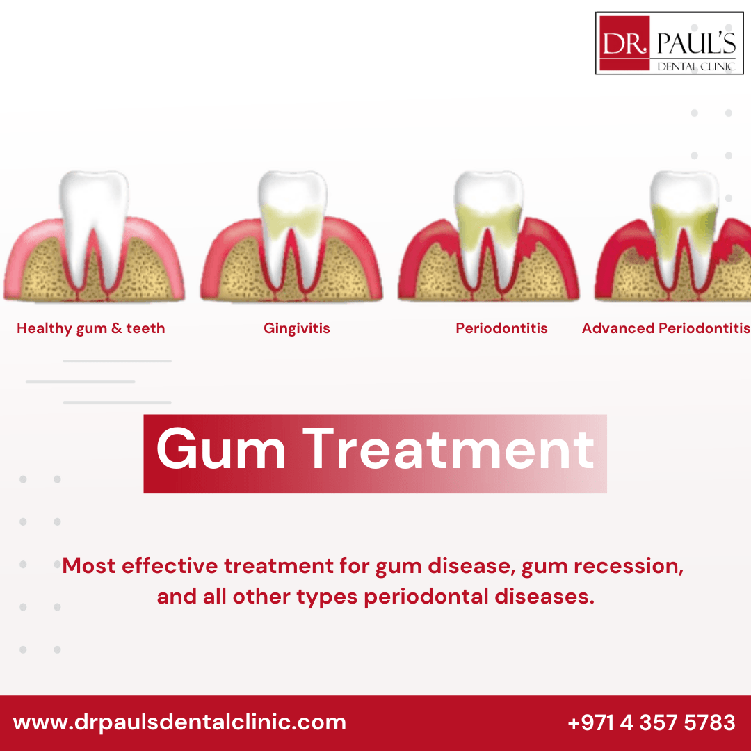 Gum Disease Treatment In Dubai