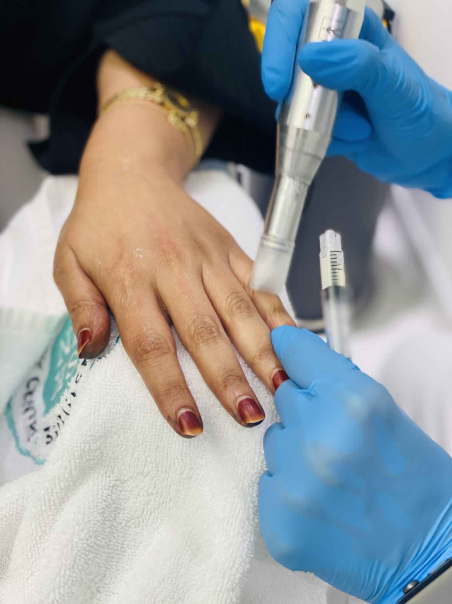 Skin Care Treatments Best Skin Clinic Abudhabi Hand Rejuvenation