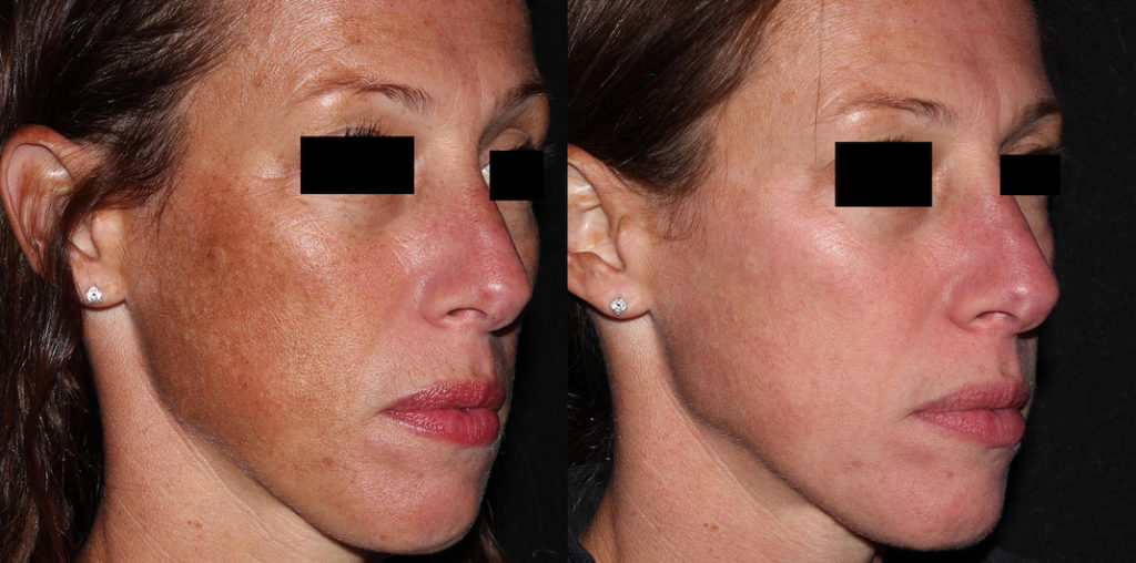 Laser Pigmentation Treatment Abu Dhabi Picosure Laser Abu Dhabi