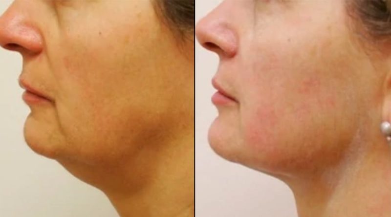 Best Face Lifting Treatment In Abu Dhabi Skin Clinic