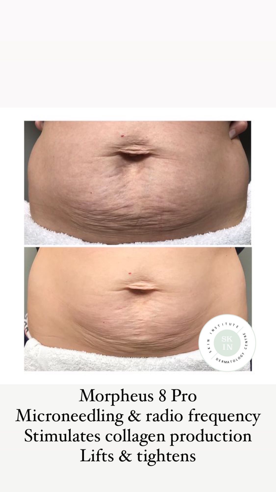 Skin Tightening Treatment Abudhabi Morpheus Rf Scarlet Rf