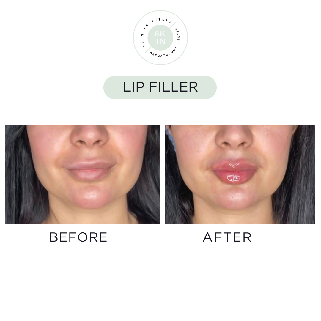 Lip Filler Services Skin Institute Dermatology Clinic Abu Dhabi