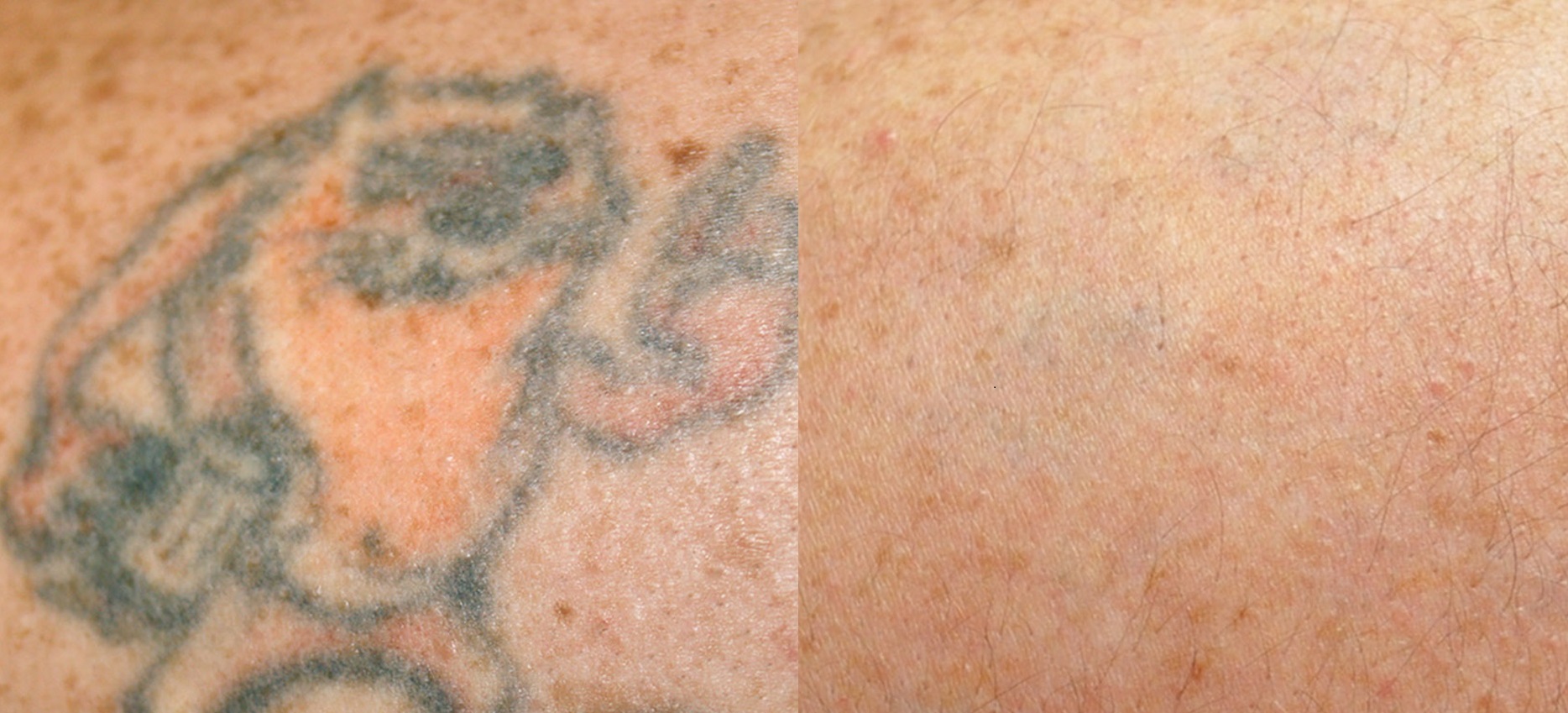 Aesthetic Clinic Fillers Sculptra Nad Iv Iv Drips Tattoo Removal