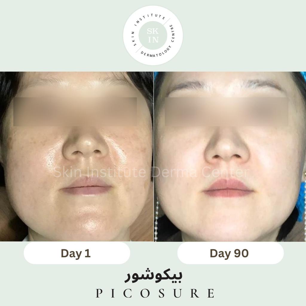 Dermatology Clinic Picosure Botox in Dubai