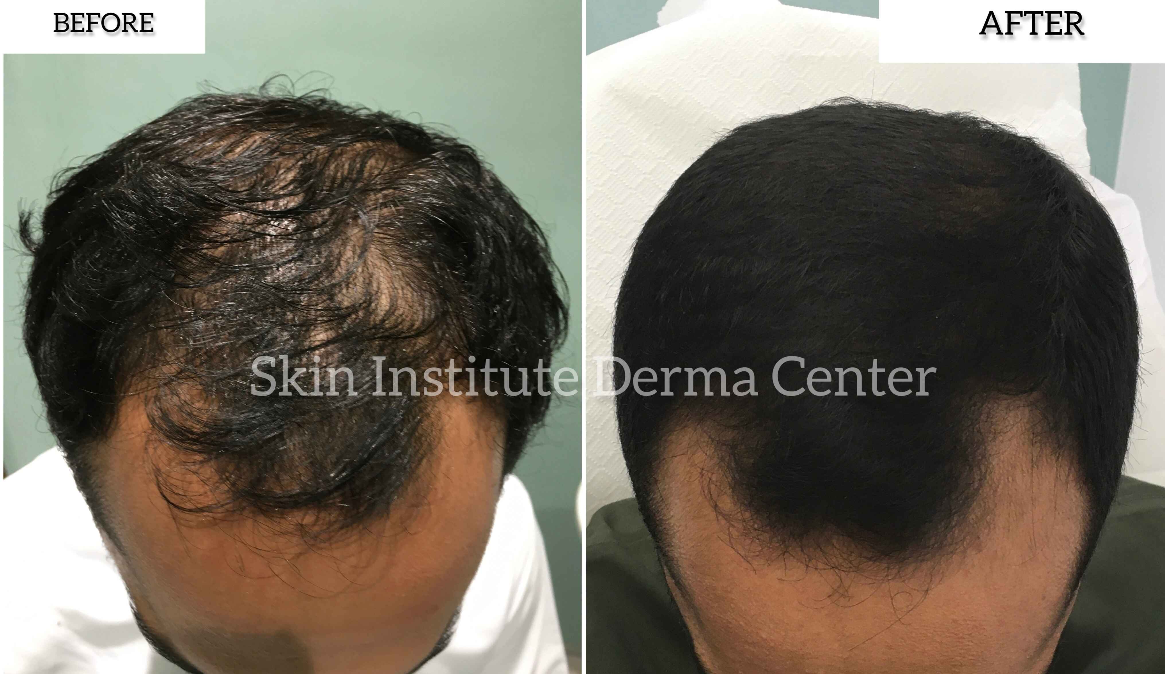 Best Prp Hair Treatment In Abu Dhabi Skin Clinic