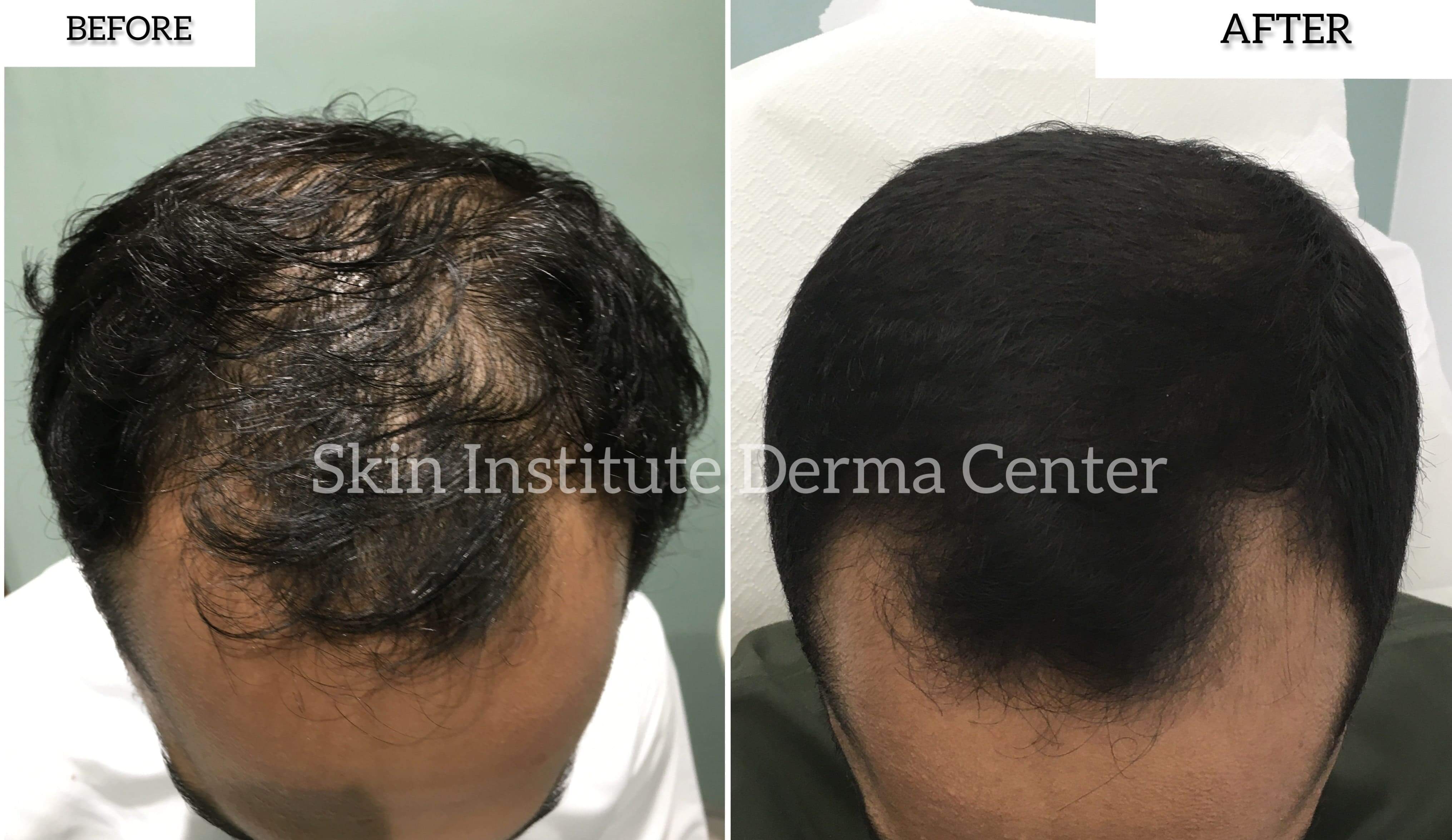 Hair Loss Treatments Hydrafacial Microneedling Rf