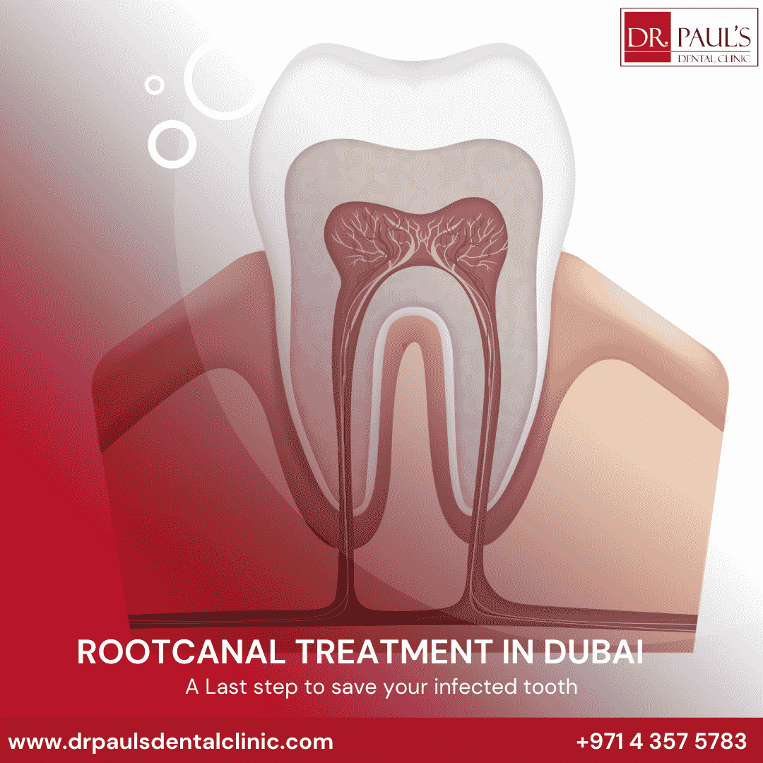 Root Canal Treatment By Specialist Endodontist In Dubai