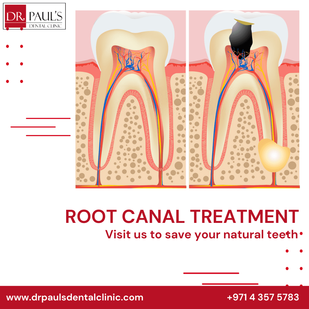 Painless Root Canal Treatment In Dubai