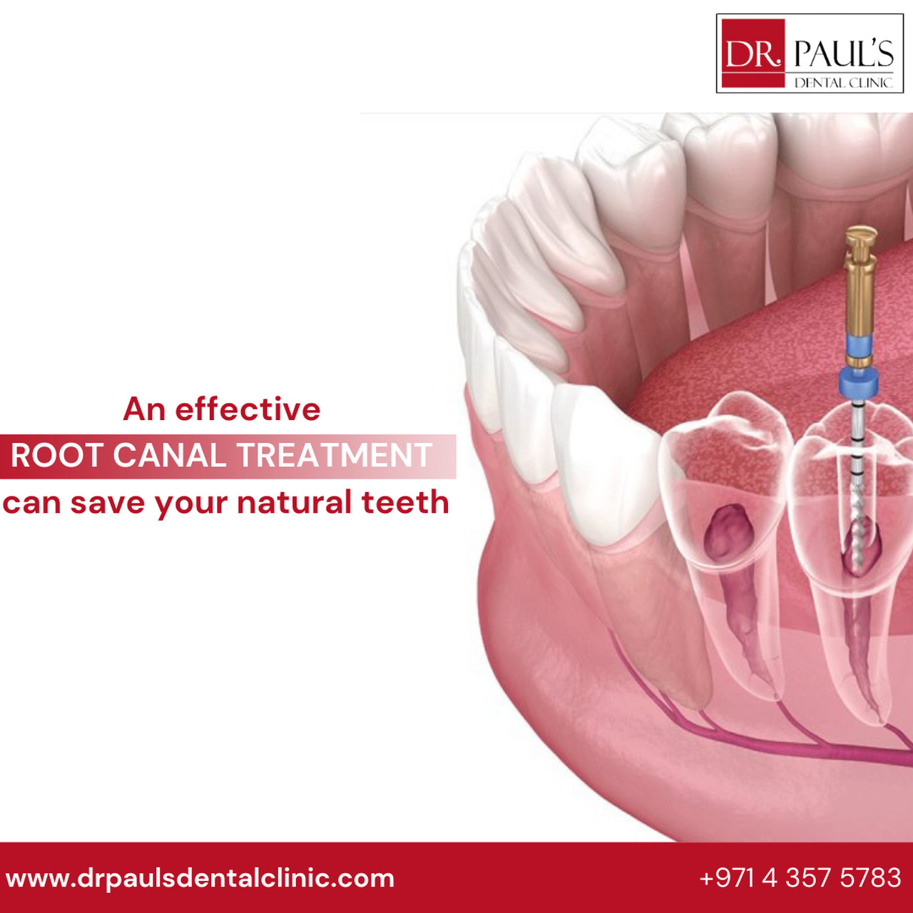 Save Your Infected Tooth With Root Canal Treatment