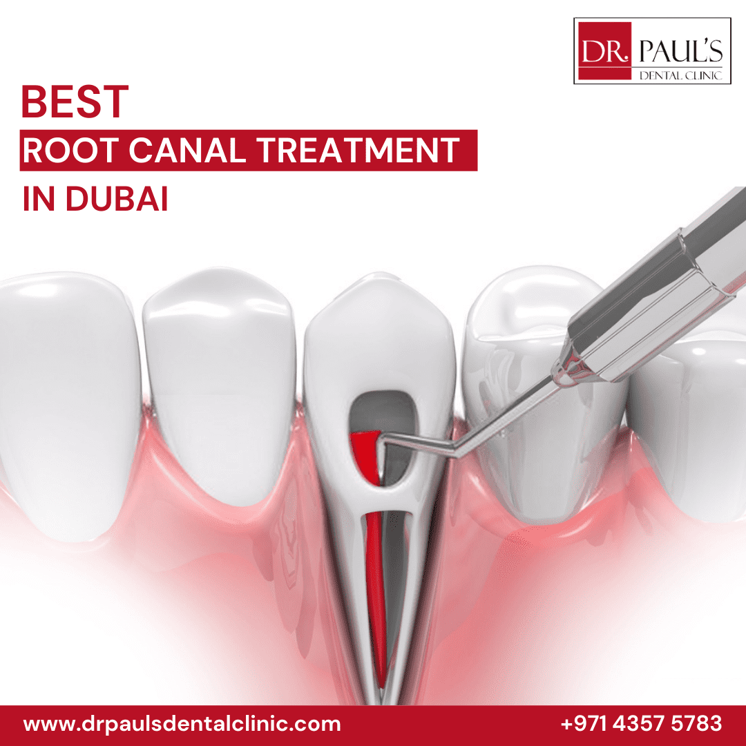 Looking For Best Root Canal Treatment In Dubai