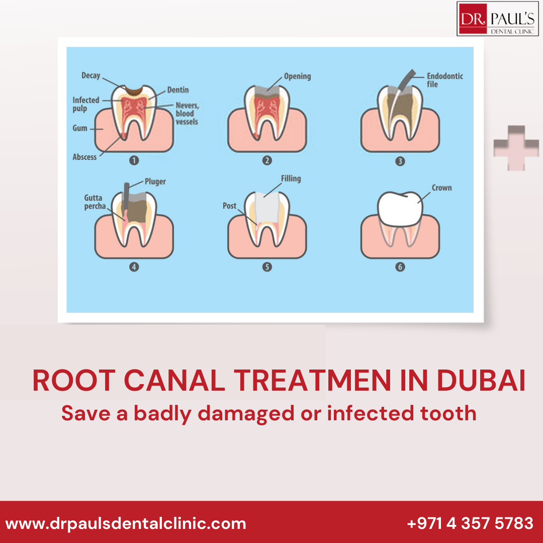Save A Badly Damaged Or Infected Tooth With Root Canal Treatment