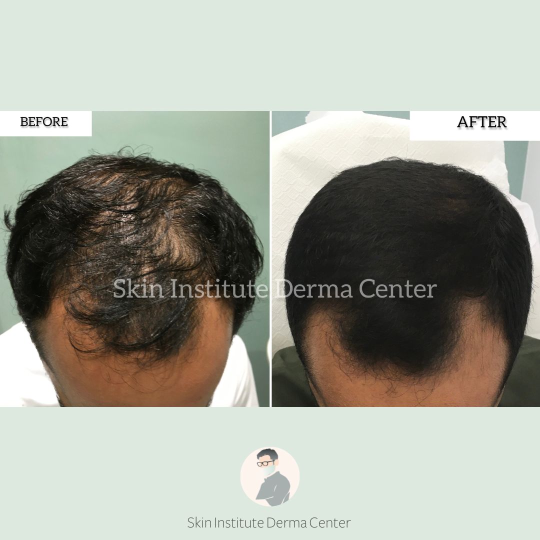 Best Hair Specialist Abudhabi Prp Treatment In Abudhabi Prp Clinic