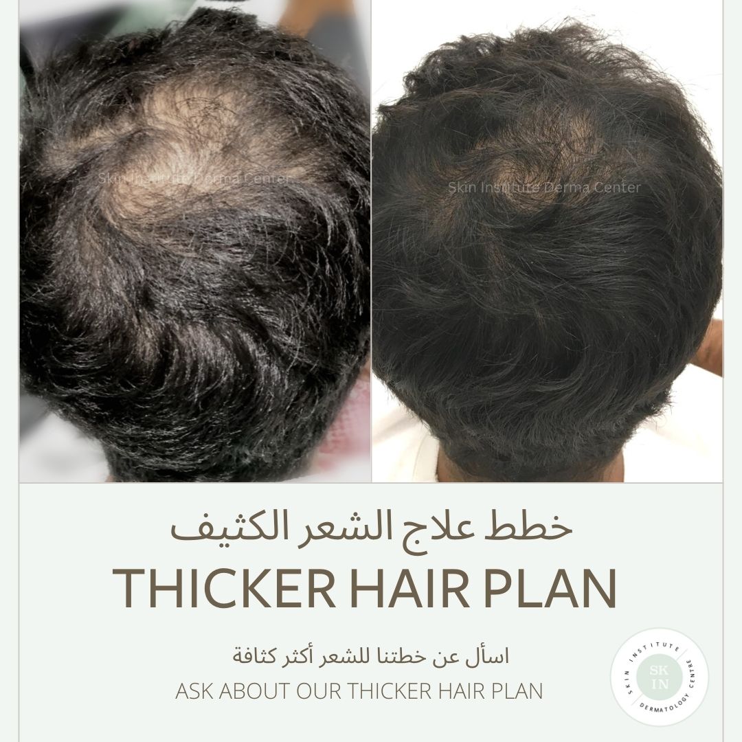 Best Hair Specialist Abudhabi Prp Treatment In Abudhabi Prp Clinic